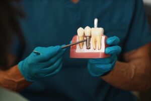 What to Know About Dental Implants in Etobicoke