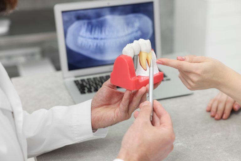 Dental Implants Etobicoke: Why Some Patients Choose to Start Treatment Before Summer